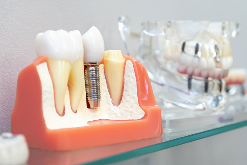 Unsure About Which Type Of Dental Implant In Cincinnati, OH You Should Get Treated With? We Can Help You Figure That Out