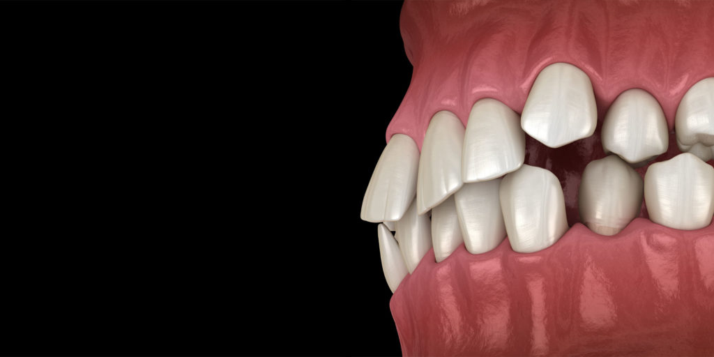 crooked teeth model