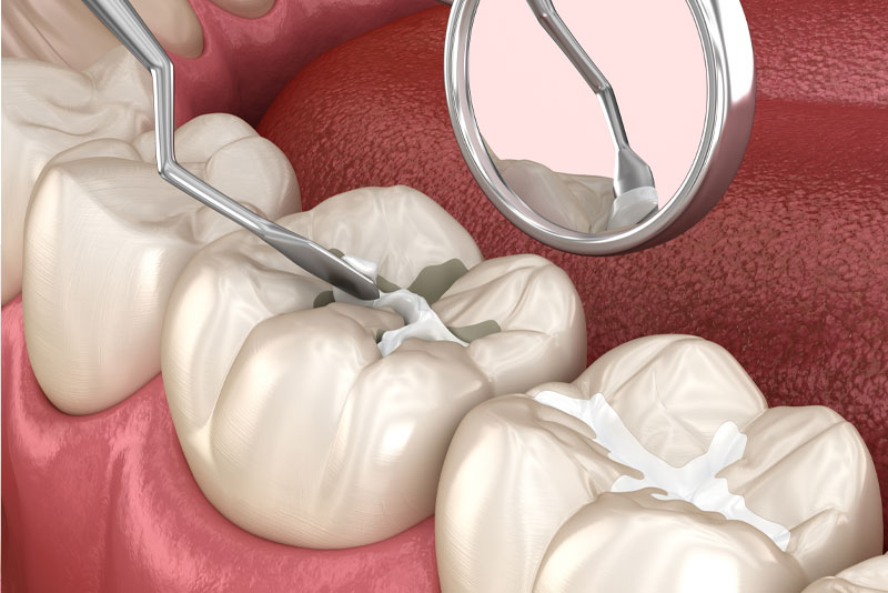 dental filling graphic