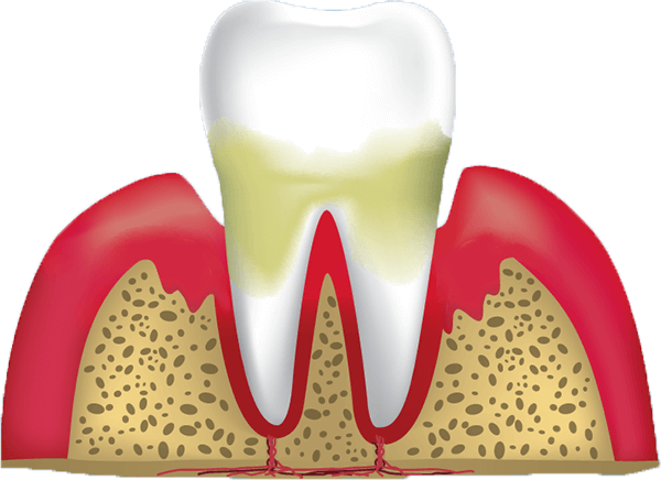 gum disease stage 3