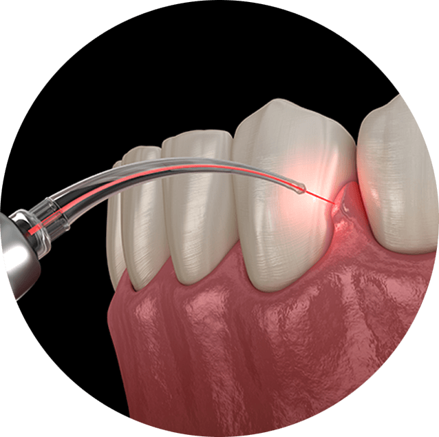 LANAP laser treatment