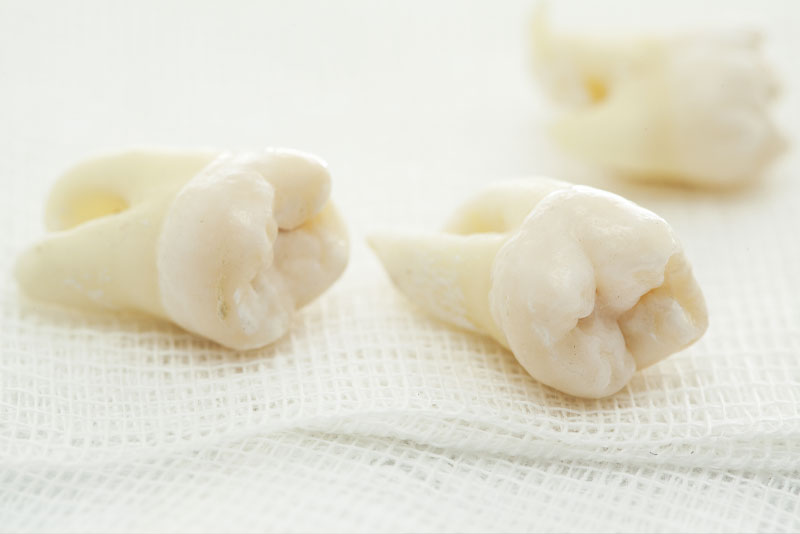 A few single dental implant models.