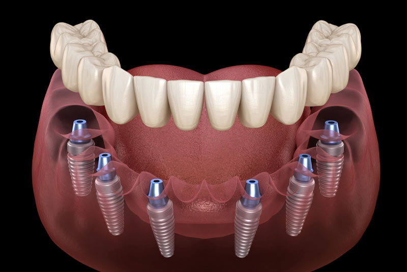 image of a full mouth dental implant model with six dental implant posts and abutments shown in the gums. the dental prosthetic is hovering over the dental implants and abutments to show where it is placed.