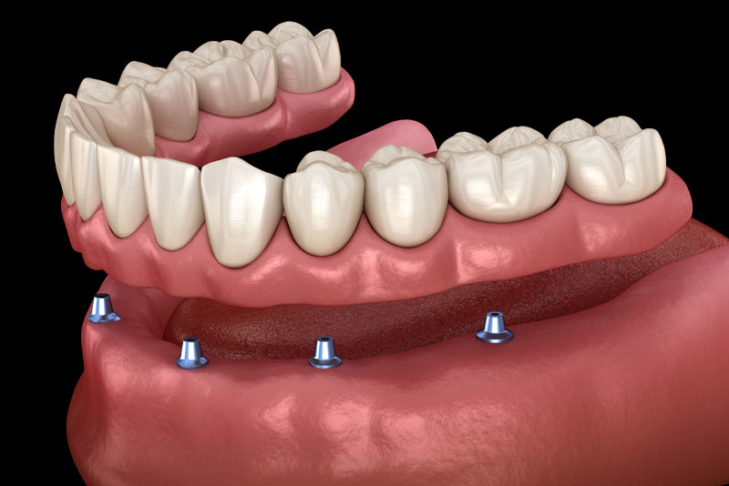 an implant supported dentures model showing four dental implant posts that the denture hovering above them will be securely placed on.