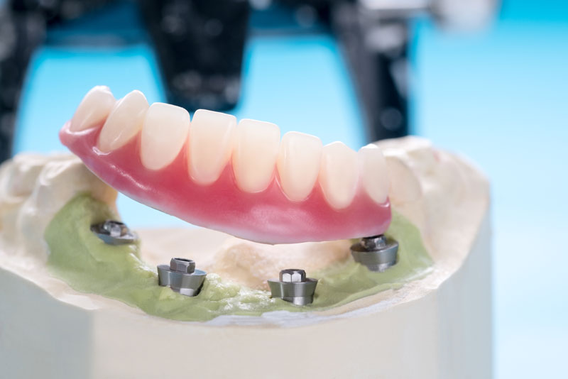 Will My Smile Be Stable And Comfortable With Implant Supported Dentures?
