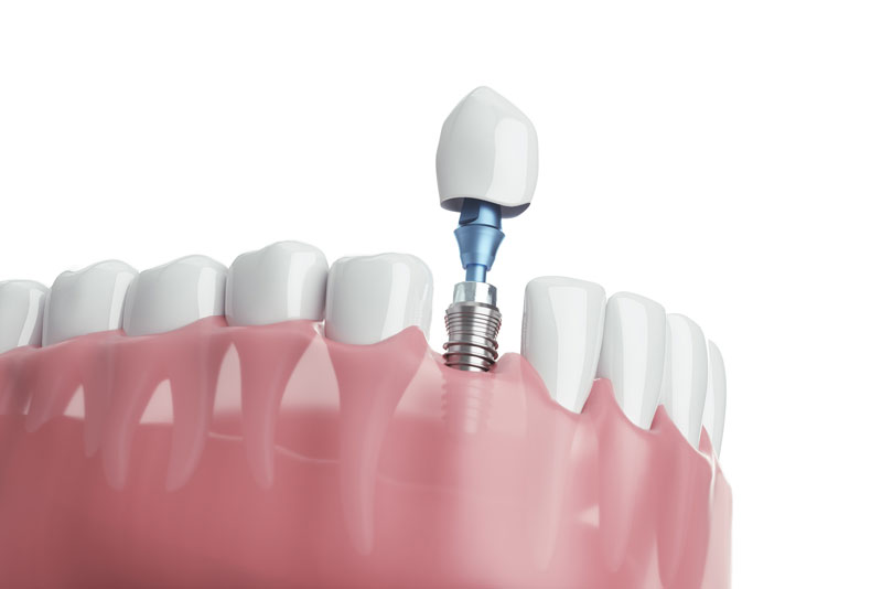 a dental implant model with an abutement being placed.