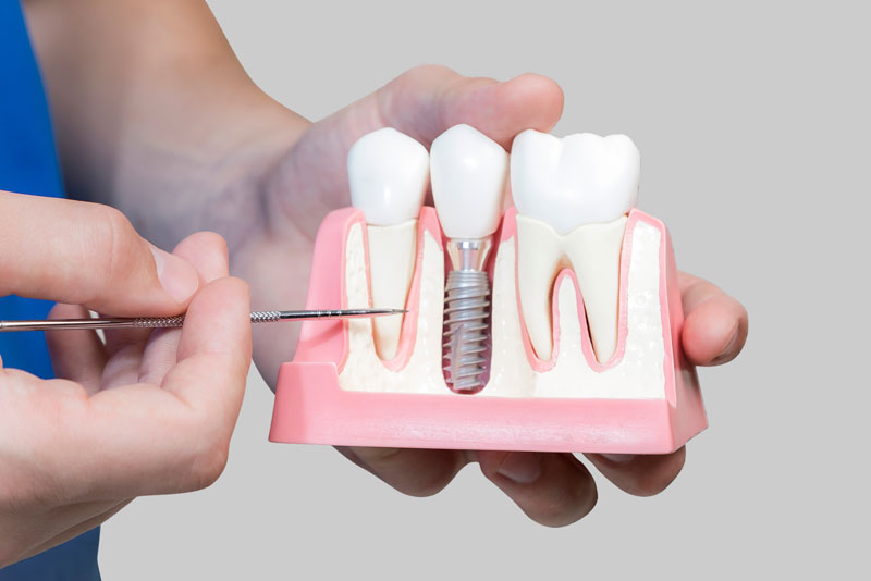 Are There Specific Parts That Make Up A Dental Implant?