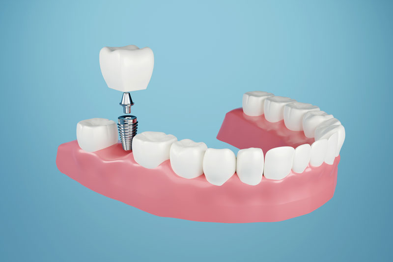 Are There Factors That Determine Which Type Of Dental Implant Procedure I Will Need To Restore My Smile?
