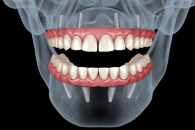 an all of 4 full mouth dental implant digital model visual.