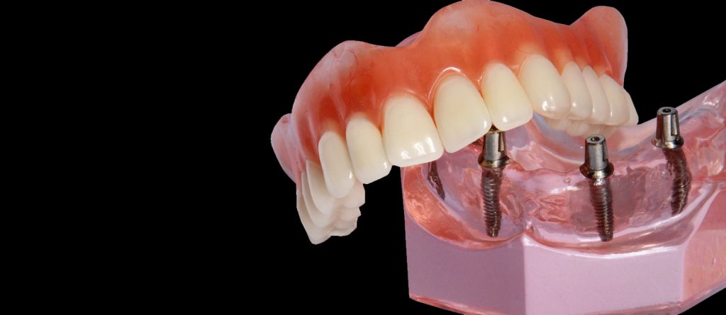 a 3D model of an implant supported denture.