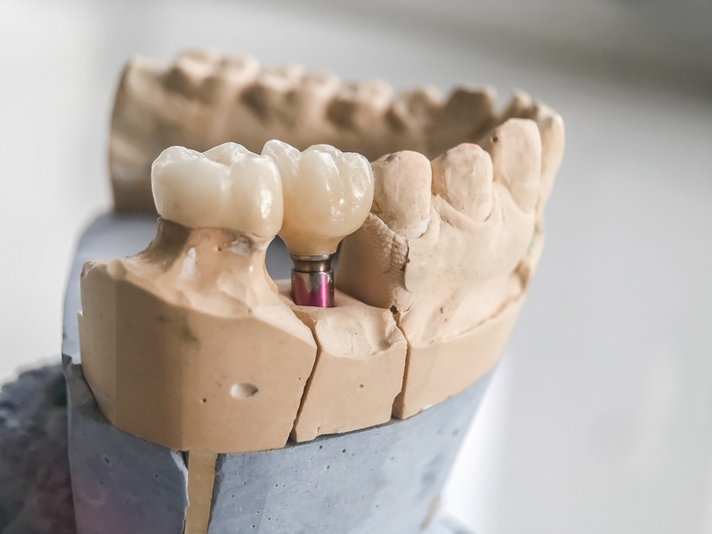 Image of a prosthesis jaw with a implant