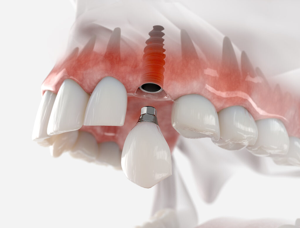 an image of a tooth implant.