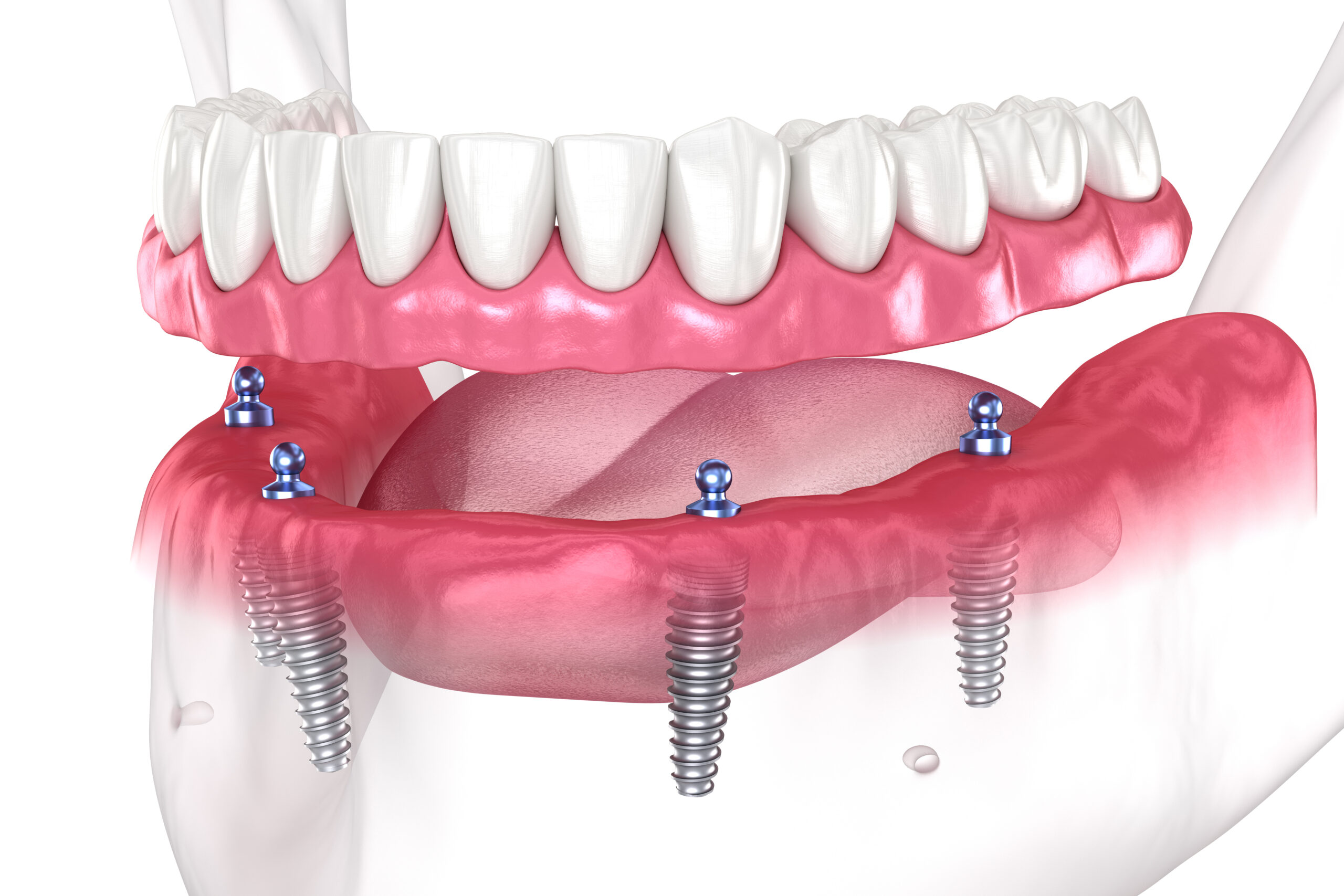 Want To Know The Benefits Of Full Mouth Dental Implants In Cincinnati, OH? Here Is What They Are