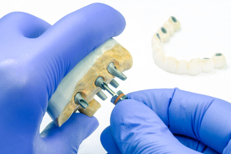 a dental implant being custom made near cincinnati oh.