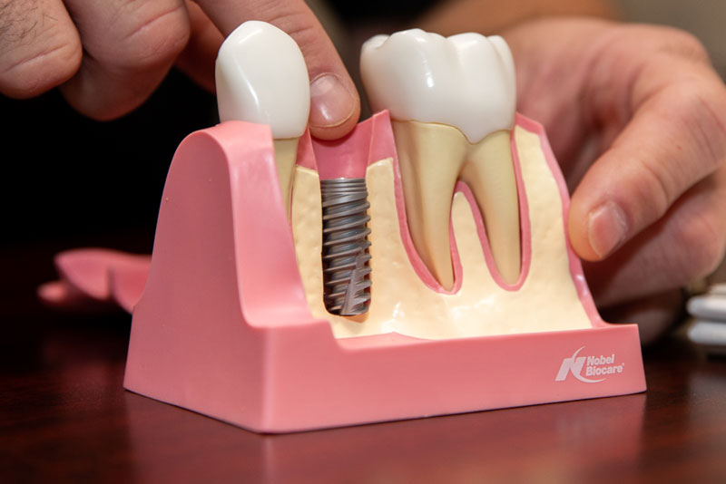 a single dental implant model showing a dental implant post.
